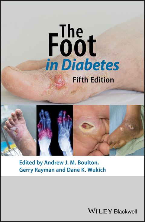 Foot in Diabetes - 