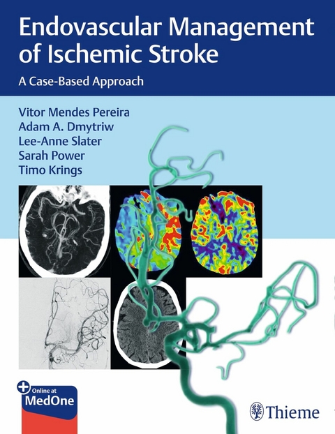 Endovascular Management of Ischemic Stroke - Vitor Pereira, Adam Dmytriw, Lee-Anne Slater, Sarah Power, Timo Krings