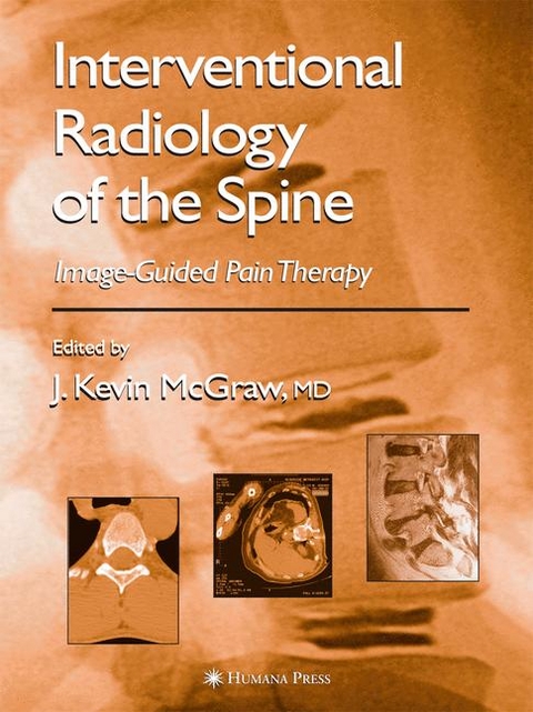Interventional Radiology of the Spine - 