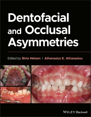 Dentofacial and Occlusal Asymmetries - 