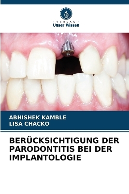 Berücksichtigung Der Parodontitis Bei Der Implantologie - ABHISHEK KAMBLE, Lisa Chacko