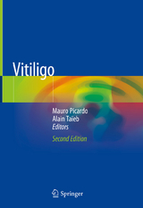 Vitiligo - 