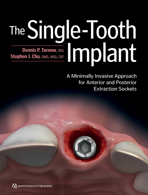 The Single-Tooth Implant: - Dennis P. Tarnow, Stephen J. Chu