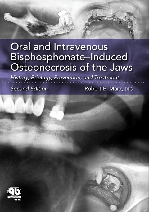 Oral and Intravenous Bisphosphonate–Induced Osteonecrosis of the Jaws - Robert E. Marx