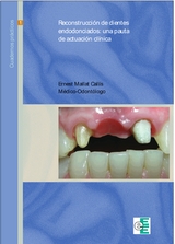 Reconstrucción de dientes endodonciados - Ernest Mallat Callís