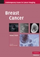 Breast Cancer - Michael J. Michell