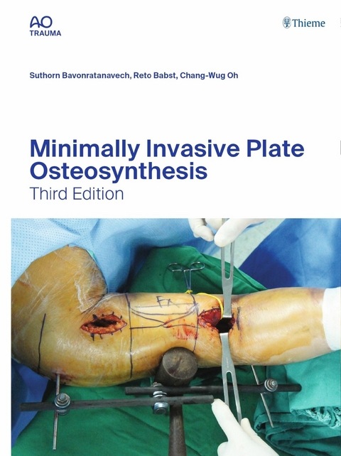 Minimally Invasive Plate Osteosynthesis -  Suthorn Bavonratanavech,  Reto Babst,  Chang-Wug Oh