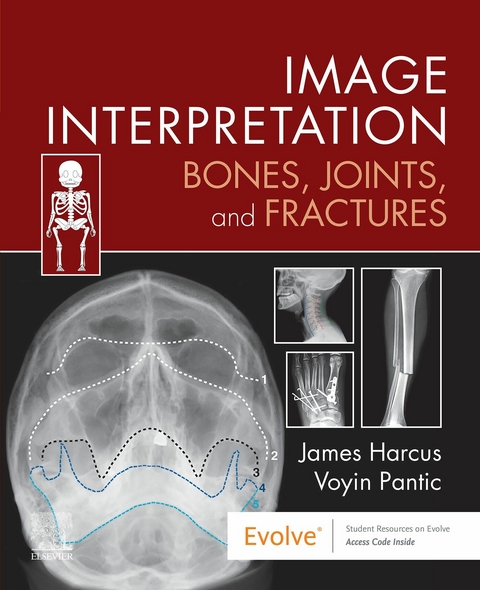 Image Interpretation: Bones, Joints, and Fractures - E-Book -  James Harcus,  Voyin Pantic