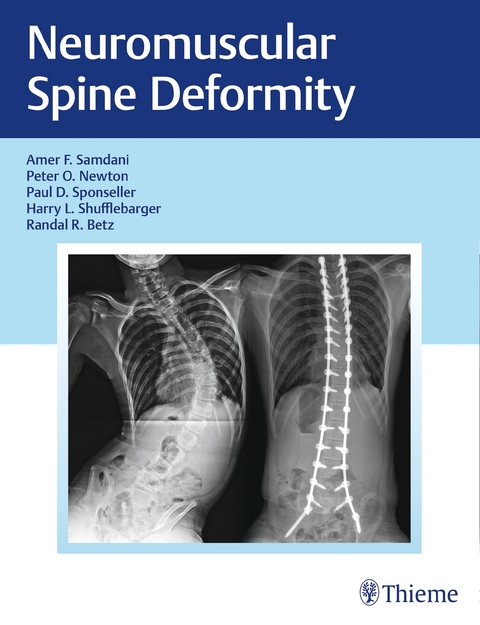 Neuromuscular Spine Deformity - 