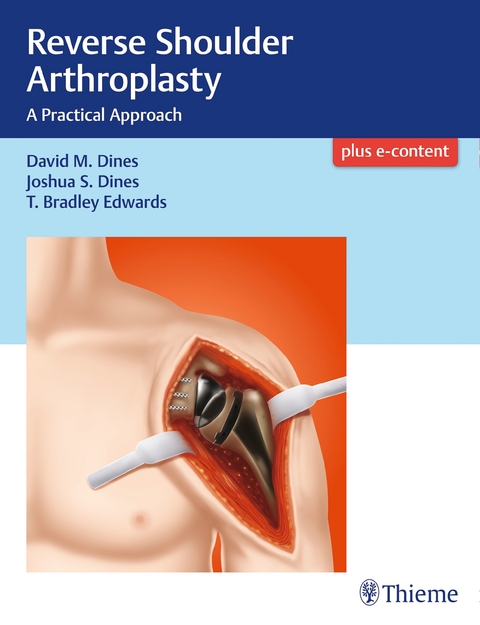 Reverse Shoulder Arthroplasty - David M. Dines, Joshua Dines, T. Bradley Edwards