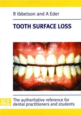 Tooth Surface Loss - R. Ibbetson, A. Eder
