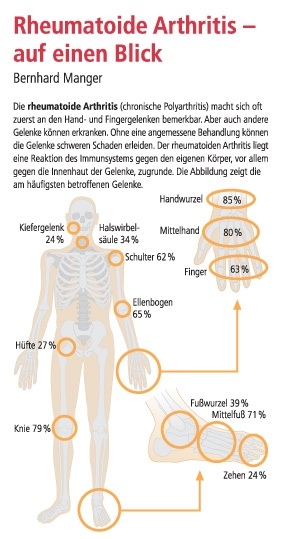 Rheumatoide Arthritis - auf einen Blick - Bernhard Manger
