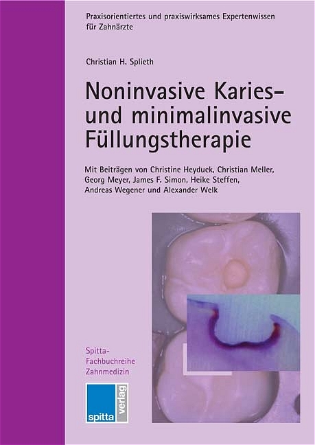 Noninvasive Karies- und minimalinvasive Füllungstherapie - Christian H Splieth