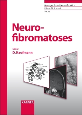 Neurofibromatoses - 