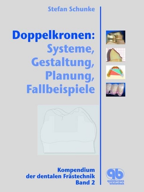 Doppelkronen: Systeme, Gestaltung, Planung, Fallbeispiele - Stephan Schunke