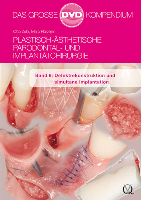 Plastisch-Ästhetische Parodontal- und Implantatchirurgie - Otto Zuhr, Marc Hürzeler