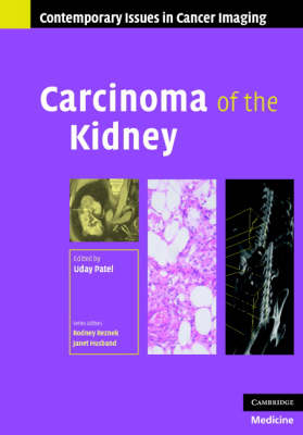 Carcinoma of the Kidney - 