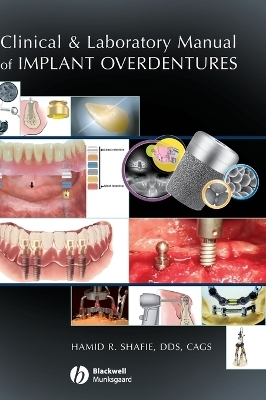 Clinical and Laboratory Manual of Implant Overdentures - Hamid R. Shafie