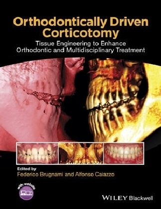 Orthodontically Driven Corticotomy – Tissue Engineering to Enhance Orthodontic and Multidisciplinary Treatment - F Brugnami