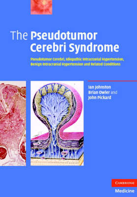 Pseudotumor Cerebri Syndrome - ian johnston; Brian Owler; John Pickard