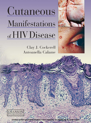 Cutaneous Manifestations of HIV Disease - Antoanella Calame; Clay Cockerell