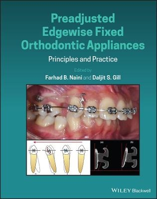 Preadjusted Edgewise Fixed Orthodontic Appliances - 