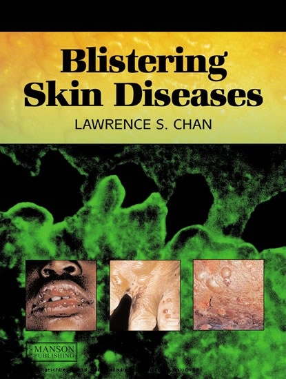 Blistering Skin Diseases -  Lawrence Chan